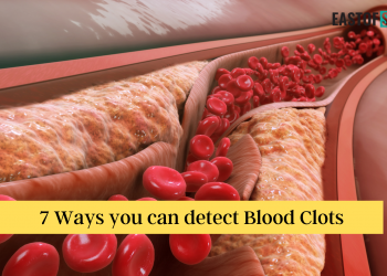 7 Ways you can detect Blood Clots